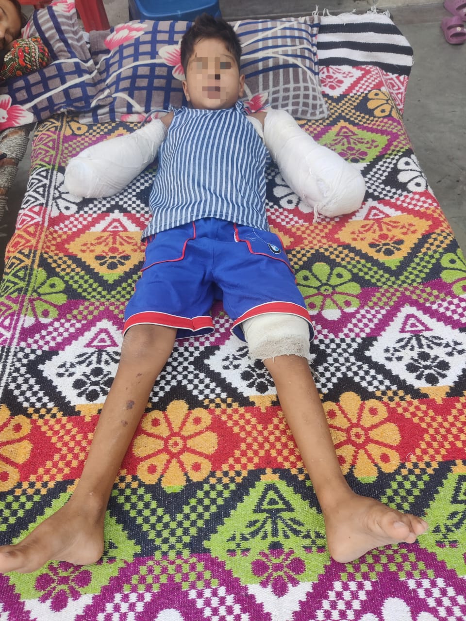 11 हजार वोल्ट की चपेट में आने से मासूम के कटे दोनों हाथ, बिजली निगम की लापरवाही आई सामने