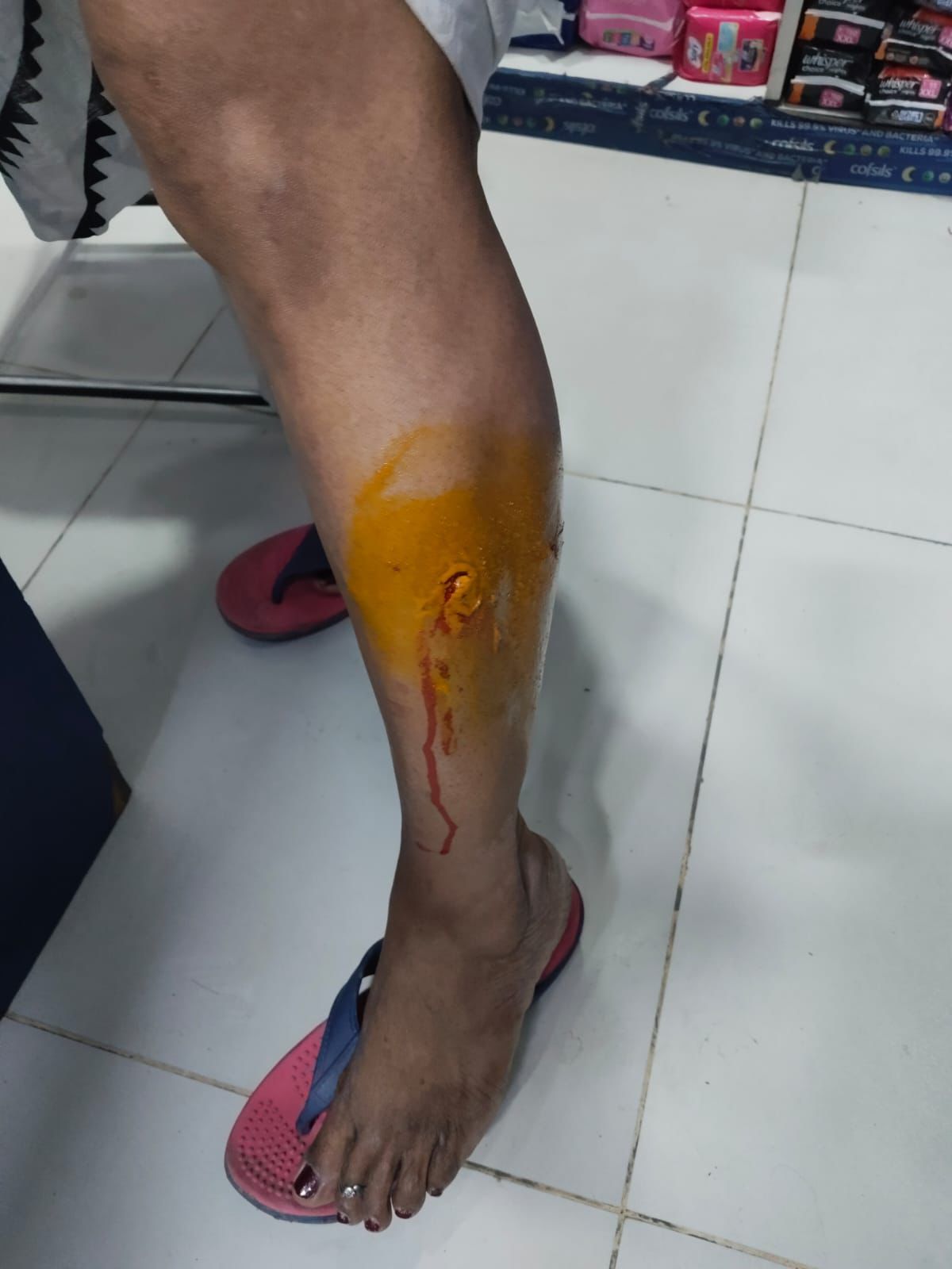 बीटा एक सेक्‍टर में महिला पर कुत्‍ते ने किया हमला:कुछ माह के दौरान सेक्‍टर में 3 लोगों पर कुत्‍ते का हो चुका है हमला